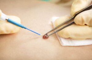 Skin Wart Removal
