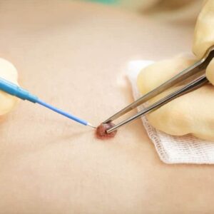 Skin Wart Removal