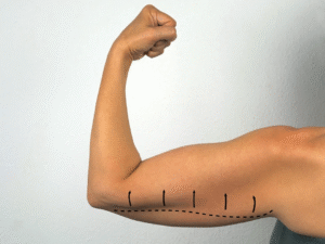 Smooth Away Sagging Skin with Arm Lift Treatments