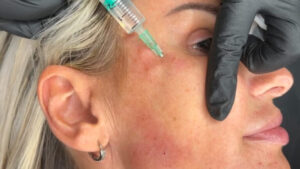 Targeted Skin Treatments with Mesotherapy