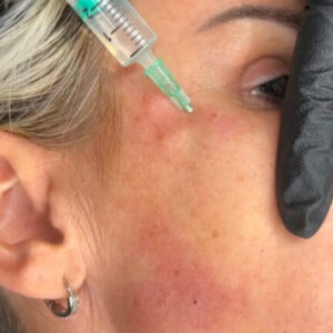 Targeted Skin Treatments with Mesotherapy