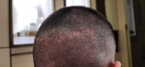 The Gold Standard for Hair Restoration FUT