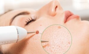 Skin Wart Removal