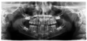 Panoramic Dental X-Ray