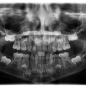 Panoramic Dental X-Ray