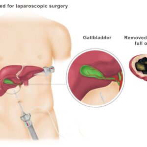 gallbladder specialist singapore
