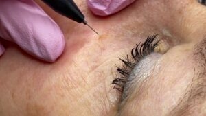 Skin Wart Removal
