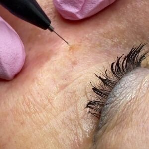Skin Wart Removal