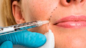 Permanent Skin Whitening Injection
