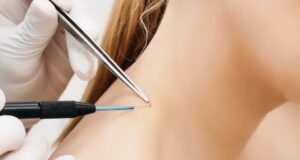 Skin Wart Removal