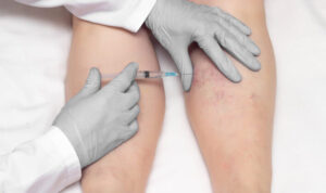 Affordable Sclerotherapy Options