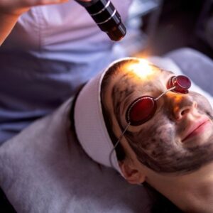Carbon Laser Facial