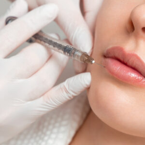 Lip Augmentation for a More Attractive Smile