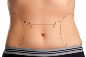 How to Prepare for Tummy Tuck Surgery