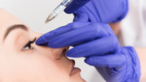 Liquid Rhinoplasty for Hump Camouflage