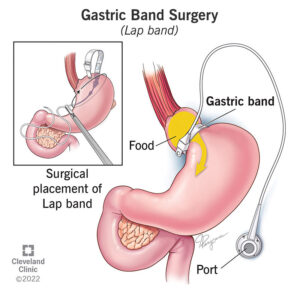 Long-Term Weight Loss Success with Gastric Banding