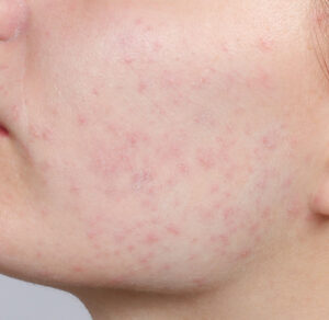 Non-Invasive Acne Treatments