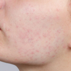 Non-Invasive Acne Treatments