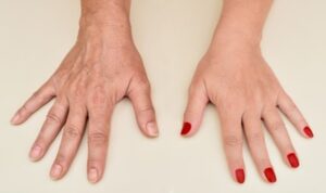 Radiant and Youthful Hands with Non-Surgical Rejuvenation
