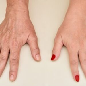 Radiant and Youthful Hands with Non-Surgical Rejuvenation
