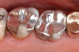 Tooth Amalgam Fillings