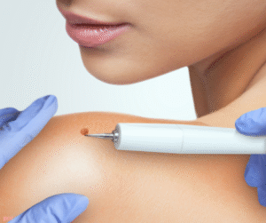 Warts Removal to Restore Smooth Skin