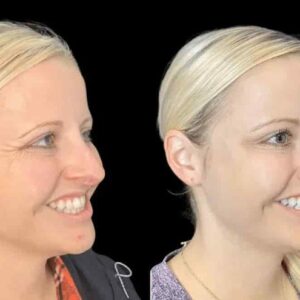 Botox in Dubai: Safe and Effective Results