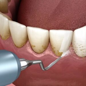 Teeth Cleaning in Dubai