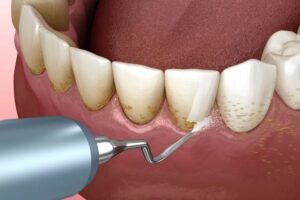 Teeth Cleaning in Dubai