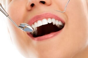 Teeth Cleaning in Dubai