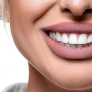 Hollywood Smile makeover in Dubai
