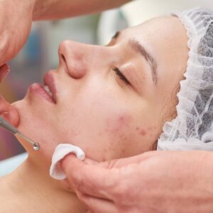 Pimples treatment in Islamabad