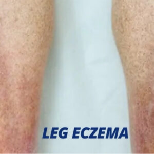 Eczema on the legs