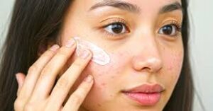Acne Treatment with Long Term Results