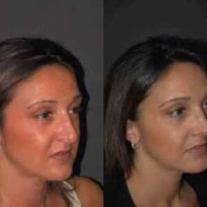 عملية تجميل الأنف في الرياض