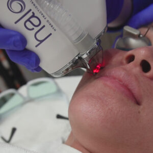 Discover Next-Level Skin Rejuvenation with Halo Treatment