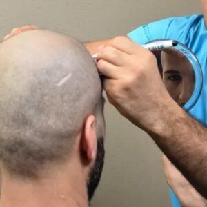 زراعة الشعر في دبي