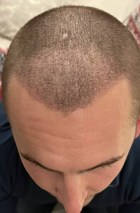 Hair Transplant Safe Advanced and Reliable