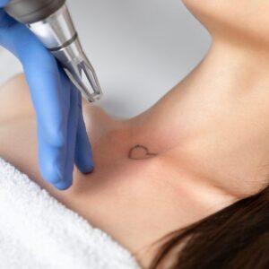 Laser Tattoo Removal