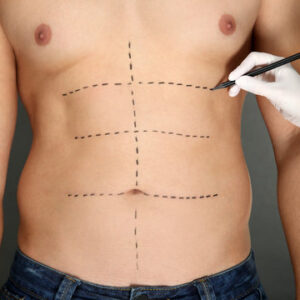 شفط الدهون في الرياض