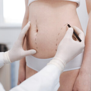 شفط الدهون في الرياض