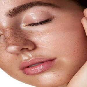 Melasma Treatment in Islamabad