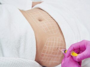 Melt Unwanted Fat with Precision