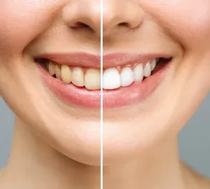 Restore Teeth After Discoloration
