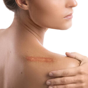 Scar Removal in Dubai