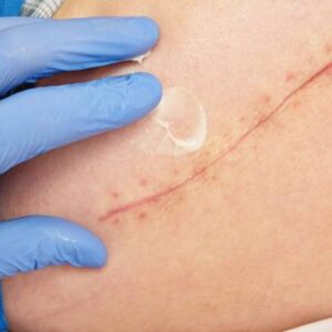 Scar Removal in Dubai