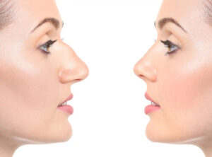 Rhinoplasty in Dubai