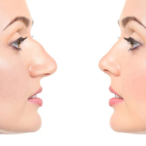 Rhinoplasty in Dubai