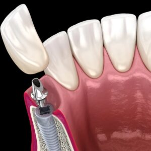 The Dental Implant Process Step-by-Step Guide for Patients