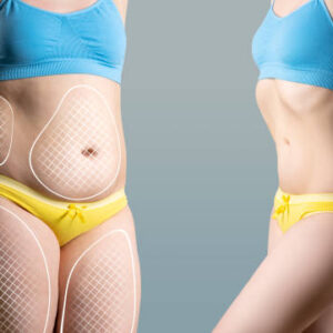 Tummy tuck in Dubai